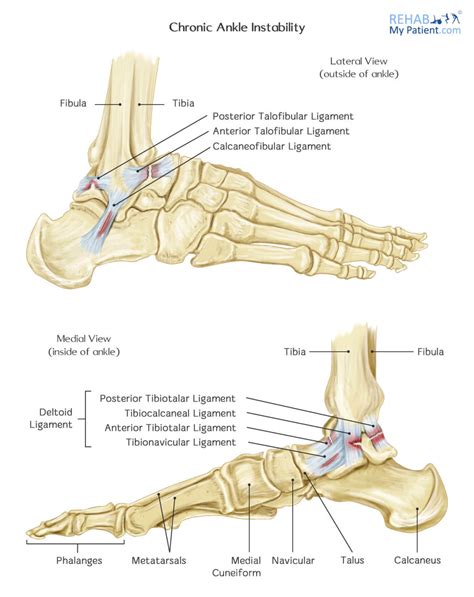 Chronic Ankle Instability | Rehab My Patient