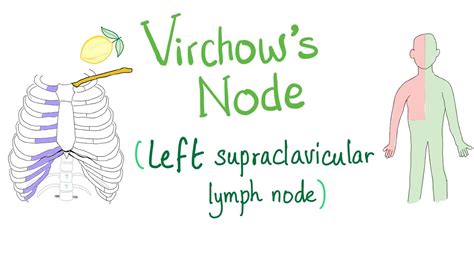 Supraclavicular lymph nodes swollen - canvasmokasin