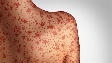 Measles symptoms: First signs of outbreak in adults and kids