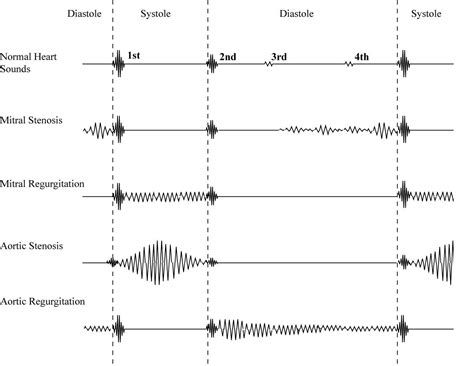 Diagram to help diagnose various heart murmurs on auscultation ...