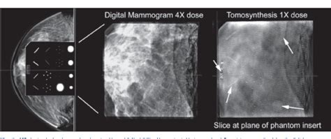 [PDF] Fundamentals of Breast Tomosynthesis Improving the Performance of ...