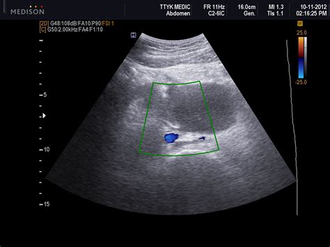 VIETNAMESE MEDIC ULTRASOUND: CASE 150: PERIUMBILICAL MASS, Dr PHAN ...