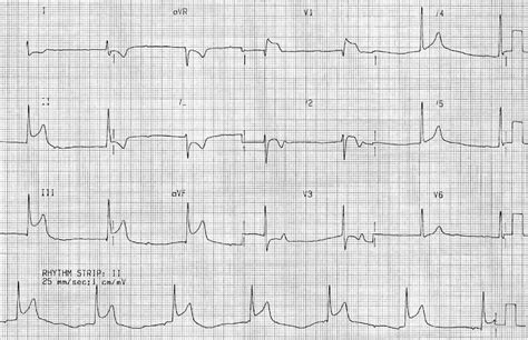 Inferior STEMI • LITFL • ECG Library Diagnosis