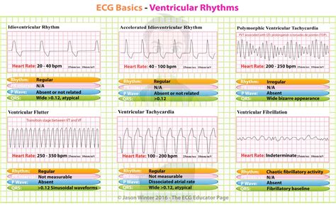 Printable Ekg Rhythms - Printable World Holiday