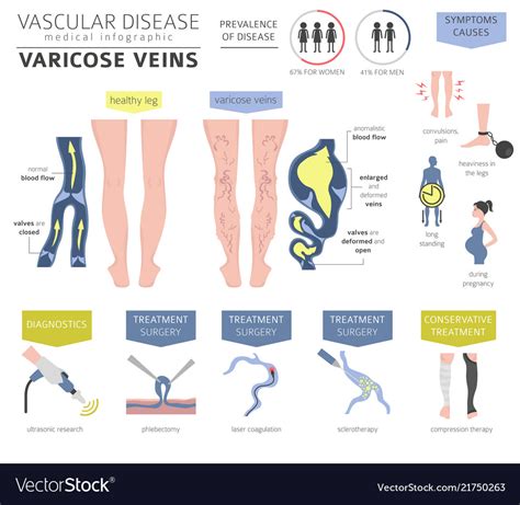 Vascular diseases varicose veins symptoms Vector Image