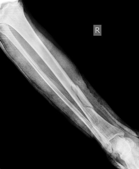 BROKEN ARM 1 | Buyxraysonline