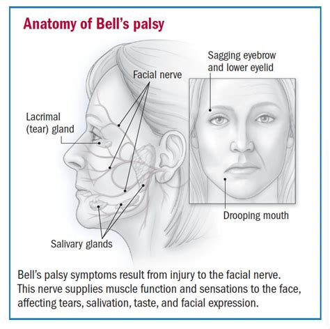 Facial palsy causes – Telegraph