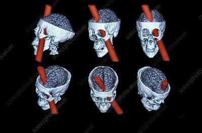 Phineas Gage brain reconstruction - Stock Image - C010/9550 - Science ...