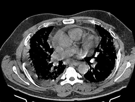 Loculated Pleural Effusion Ct Chest / Pleural Effusion Parapneumonic Md ...