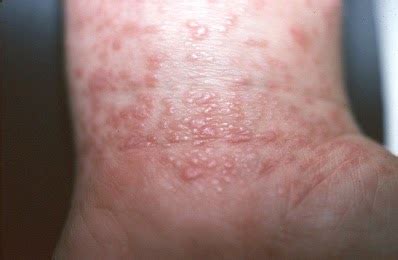 HCV New Drugs: Rash Hepatitis C /Lichen planus /Photos