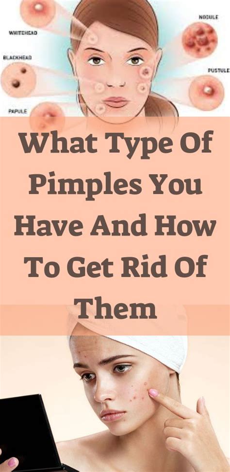 What type of pimples you have and how to get rid of them | Pimples on face