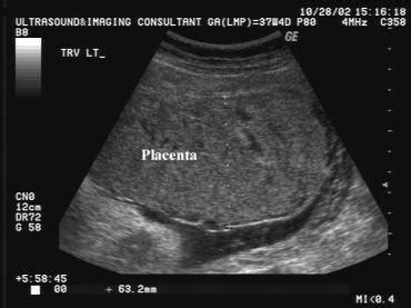 Thick Placenta