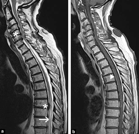 Abnormal Thoracic Spine Mri