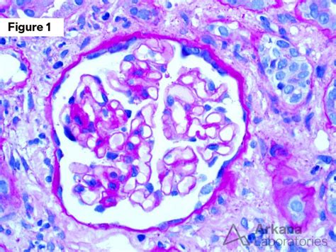 Kappa Light Chain Cast Nephropathy | Teaching Point | Arkana Labs