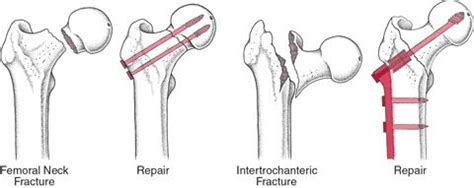 Intertrochanteric Fracture Vs Femoral Neck Fracture