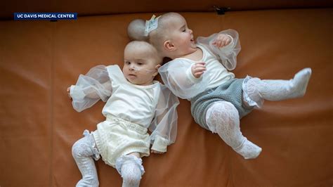 Conjoined twins successfully separated at the head in 24-hour operation