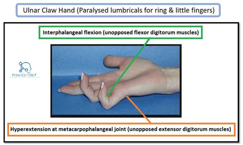 Claw Hand & Ulnar Paradox » How To Relief