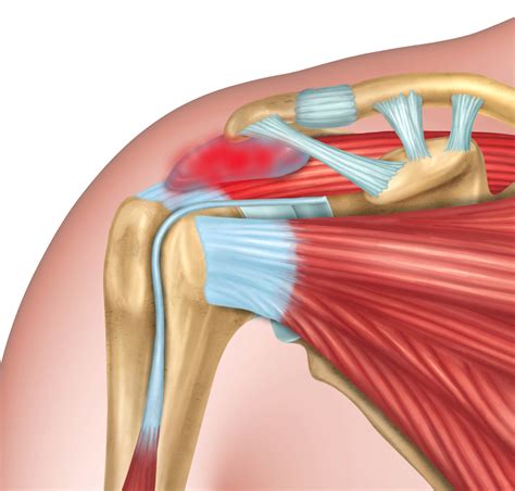 Subdeltoid Bursitis Shoulder