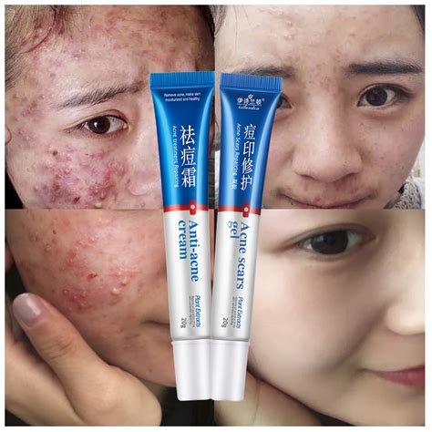 ISILANDON Face Care Clear Vanishing Acne Treatment Cream+Acne Scars ...