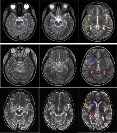 Brain MRI findings in the three siblings. T2-weighted images obtained ...