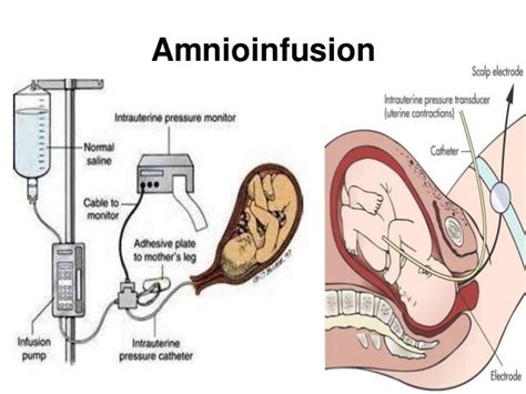 Meconium Aspiration Syndrome