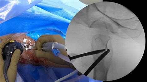 Femoroacetabular impingement surgery recovery time