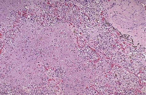 Pulmonary Pathology