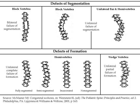 Scoliosis Progression