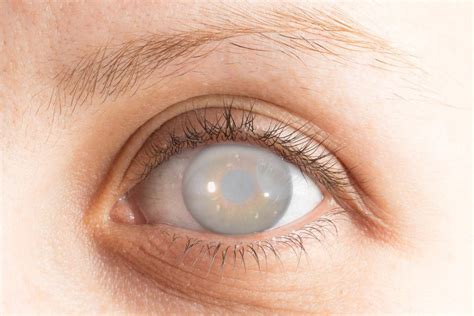 How Do Cataracts Affect Vision: InVision Eye Care: Ophthalmologists