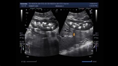 Ultrasound Video showing bilateral Medullary nephrocalcinosis and renal ...