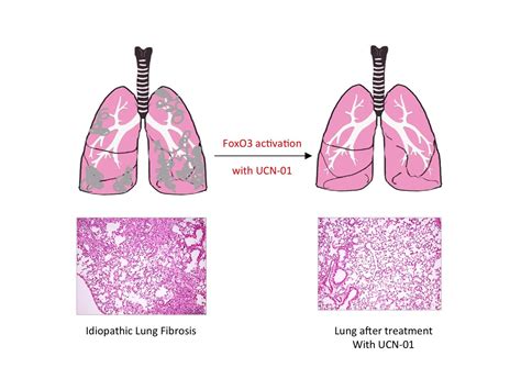 Pulmonary fibrosis caused by single transcription factor