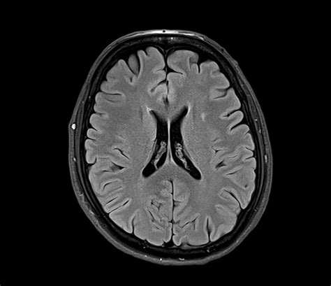 FLAIR MRI | FLAIR MRI Sequence Physics, Image and Pathology Appearance