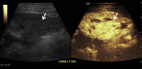 New Publication: Contrast-Enhanced Ultrasound Detects Recurrent Renal ...