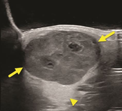 Pleomorphic Adenoma of the Parotid Gland • APPLIED RADIOLOGY