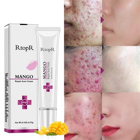 Repair Acne Cream,Acne Removal Cream, Pimple Treatment Cream Hydrating ...