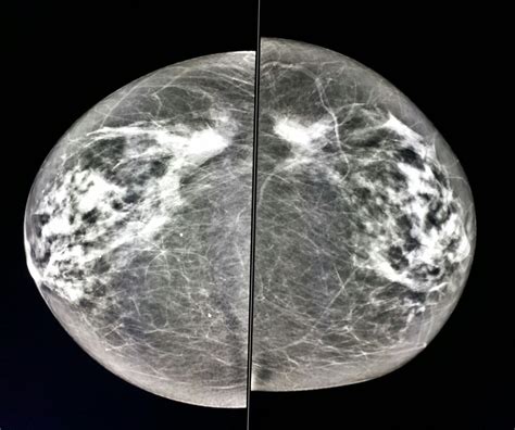 #Normal #mammogram in a #woman in for a standard #screening study. # ...