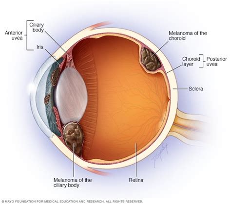 Choroidal Melanoma | What is it, Causes and Treatment