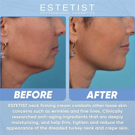 A Dermatologist Can Help To Improve The Appearance Of Your Neck By ...