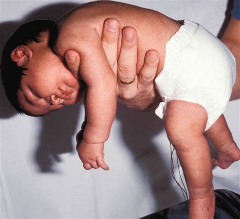 Floppy baby syndrome causes, signs, symptoms, diagnosis & treatment