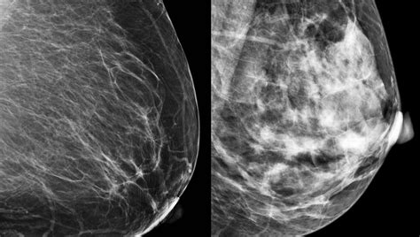 Breast Cancer Mammogram