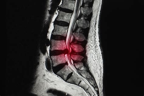 Back pain: Don’t let the MRI scare you | Next Step Health