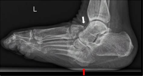 Charcot foot 101: Definition, Stages, Symptoms, and Diagnosis