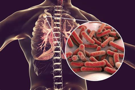 Sekundäre Tuberkulose-Lungeninfektion und Nahaufnahme von Mycobacterium ...