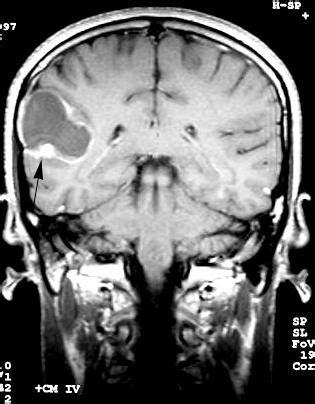 Pleomorphic xanthoastrocytoma | Eurorad