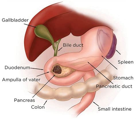 Olaparib for Pancreatic Cancer with BRCA Mutations - National Cancer ...