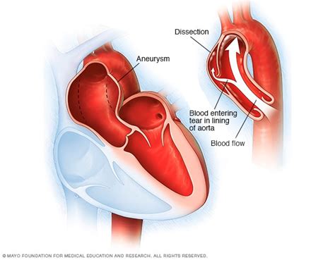 Thoracic aortic aneurysm - Symptoms and causes - Mayo Clinic