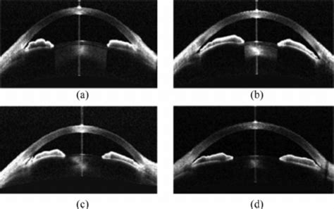 AS-OCT image of an eye with the (a) iris roll mechanism, (b ...