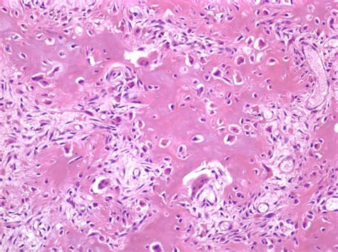 Osteoid Osteoma Histology