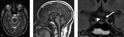 7 Empty Sella Configuration | Radiology Key