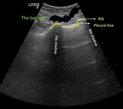 Basics of Lung Ultrasound for the Nephrologist: What are A-lines and B ...